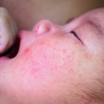 Eczema in children: How to relieve their painful itching