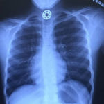 A young girl is lucky to be alive after her fidget spinner got stuck in her throat (!!!)