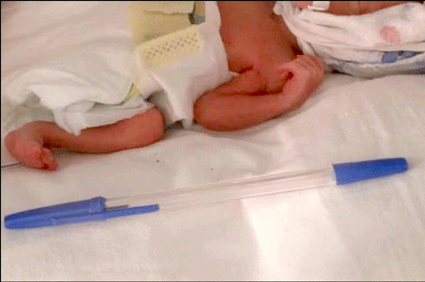 A premature baby born the ‘size of a pen’ reaches healthy weight after four months of care