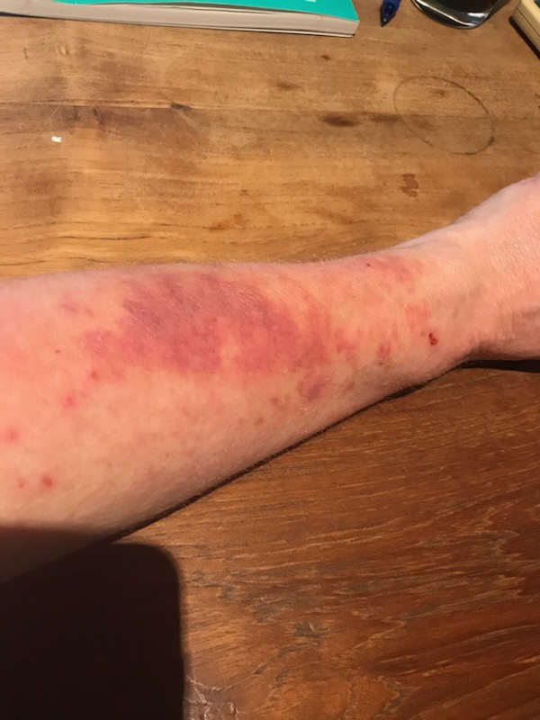 Christmas Tree Allergy Aussie mum's horror story Bounty Parents