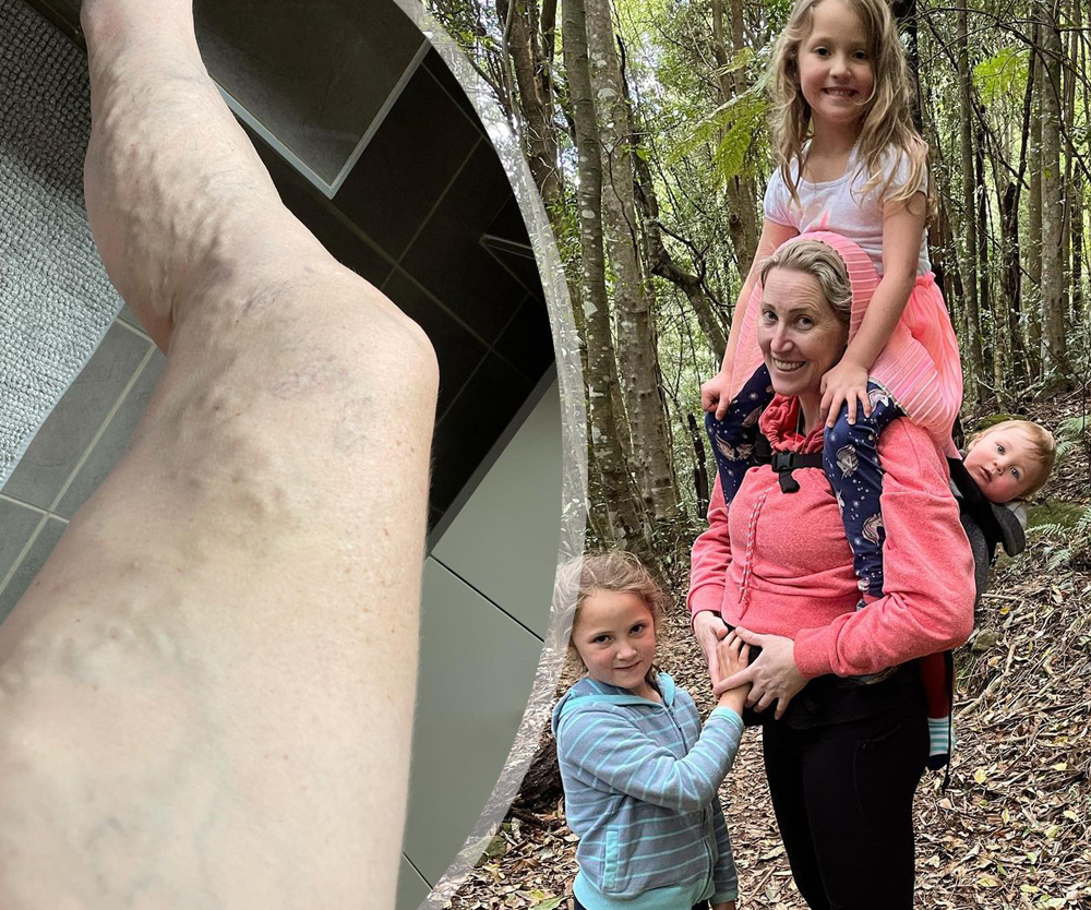 Twin mum-to-be Jana Pittman shares varicose veins and growing bump