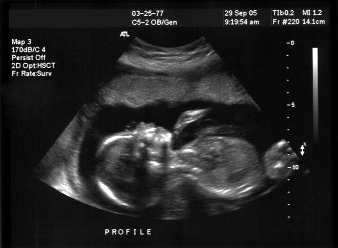 Scans, tests and screening - what to expect during your pregnancy ...