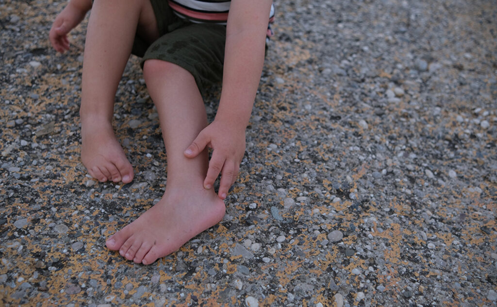 Child scratches his bare feet from mosquito bites 