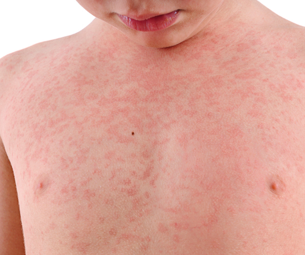 Meningococcal disease: What is it, how does it spread, and what can you do to stay safe?