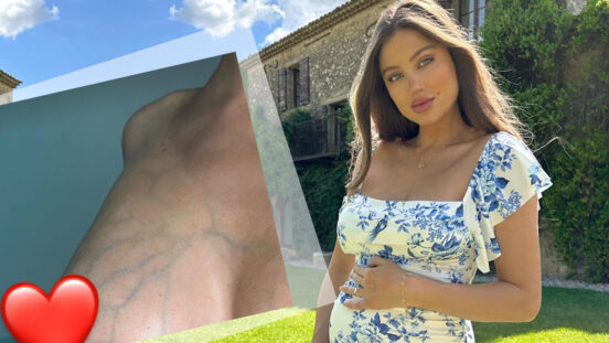 belle lucia wearing a blue and white dress cradling her baby bump plus inset image of her veiny chest