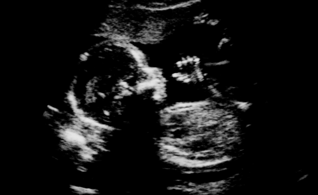 Black and white ultrasound image of a foetus sucking their thumb
