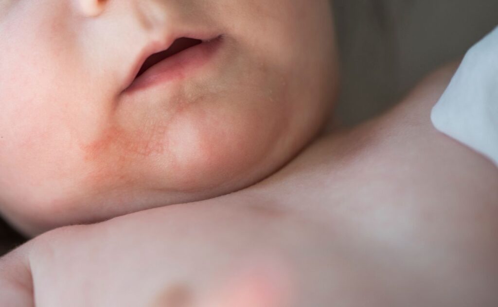 Close up of a baby's chin and upper chest where the skin looks irritated by eczema